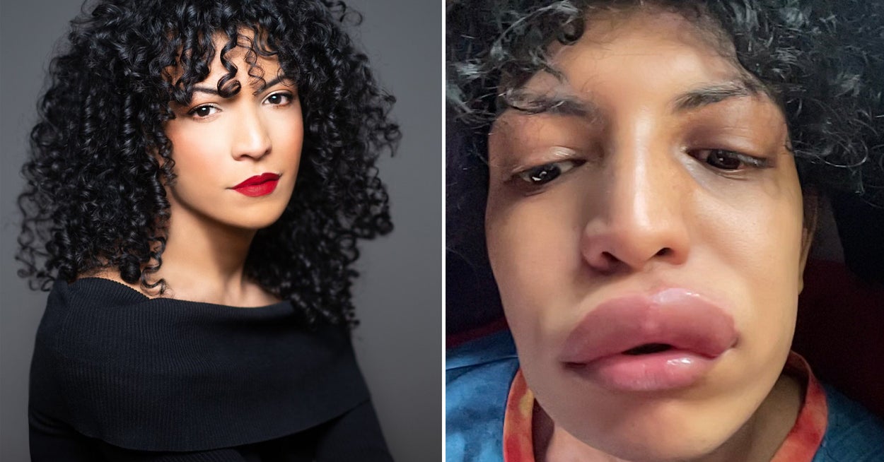 This Woman’s Allergic Reaction Was Triggered By A Kiss