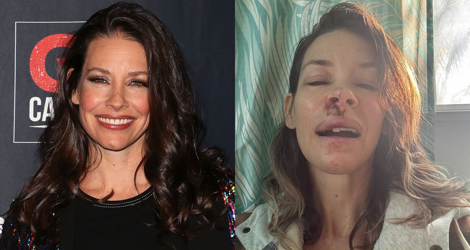 Evangeline Lilly Shows Off Bloody Injuries After Fainting & Hitting Face on Boulder
