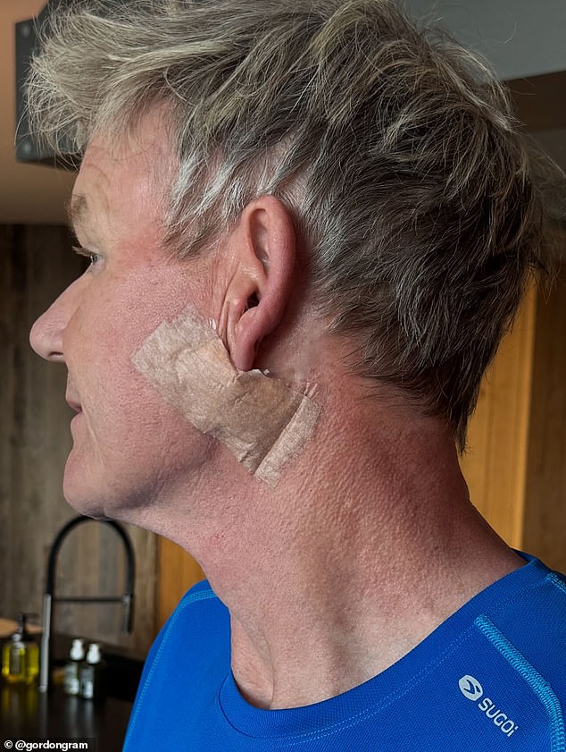 Gordon Ramsay, 58, has revealed he has undergone surgery to remove Basal Cell Carcinoma, a form of non-melanoma skin cancer