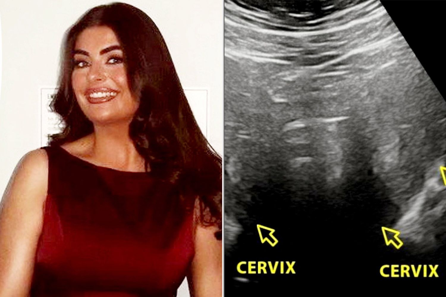 Woman Had Intense Periods, Discovered in Surgery She Has Rare 2 Wombs (Exclusive)