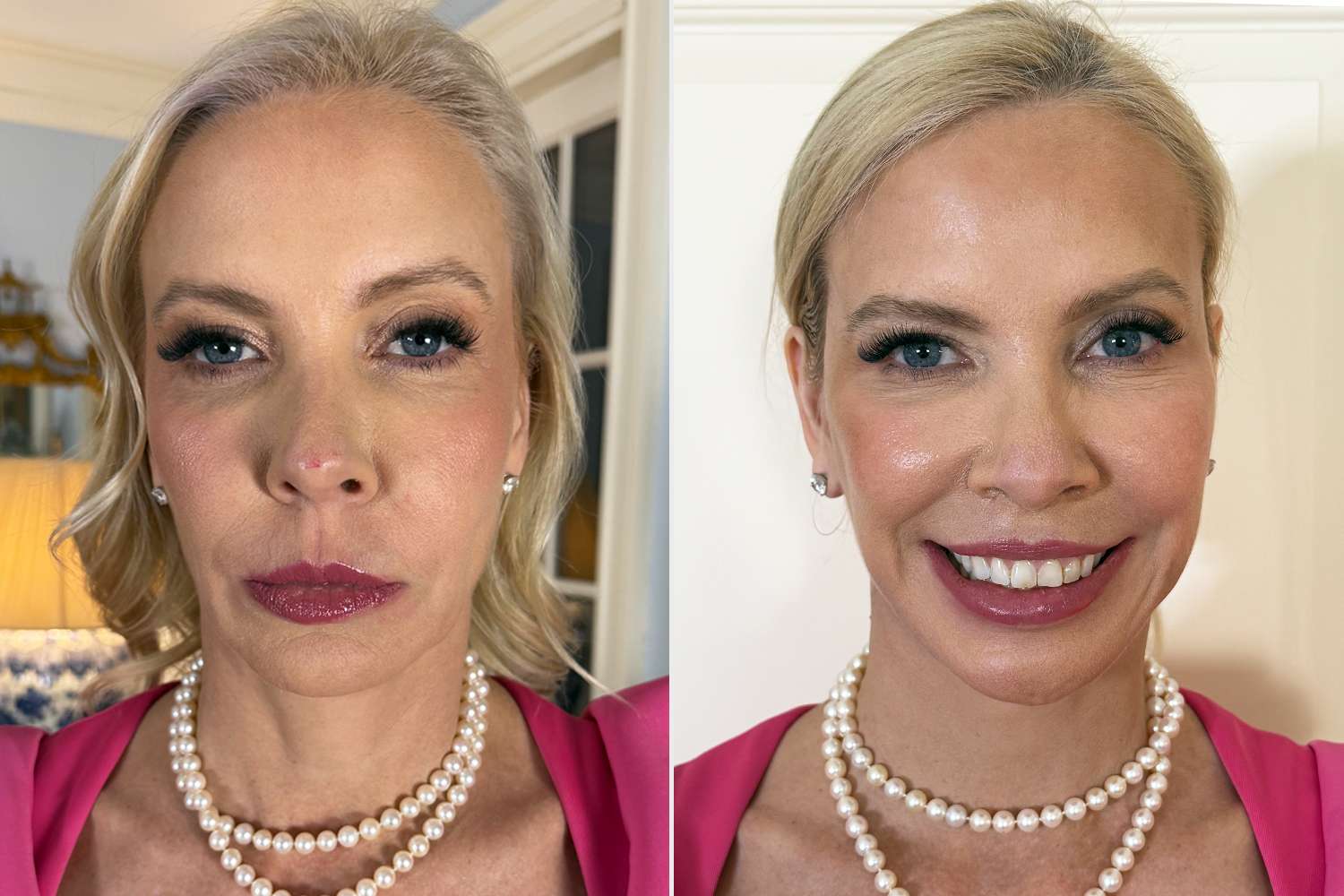 Kerry Berlet before surgery (left) and after surgery (right)Credit: Kerry Berlet