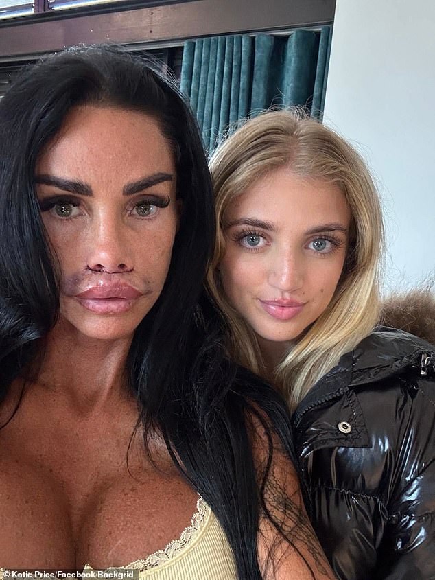 Katie Price shows off her swollen and bruised lips as she reunites with her daughter Princess after undergoing surgery to remove scar tissue caused by migrated filler